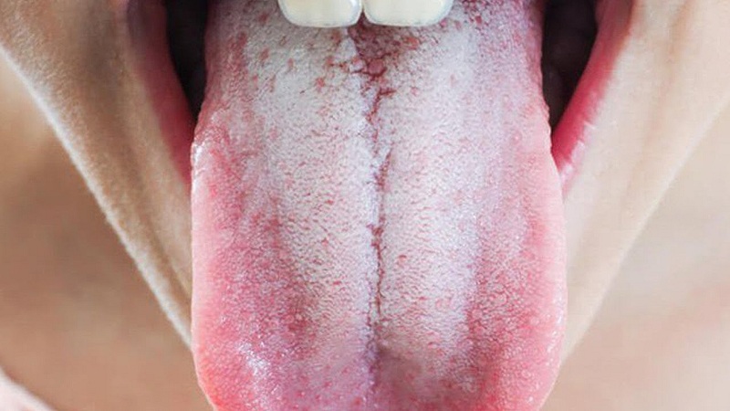 tê đầu lưỡi, nóng rát miệng là dấu hiệu của bệnh gì