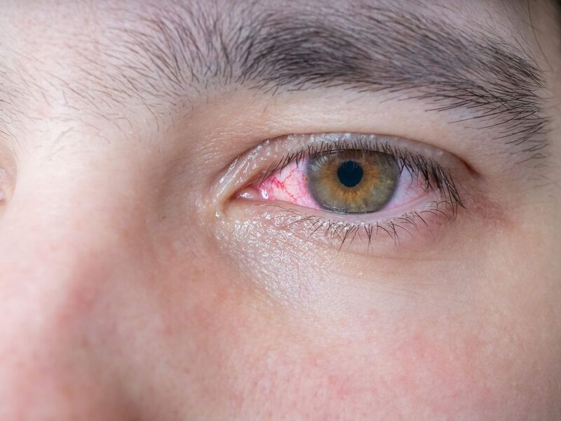 Viêm xoang sàng gây ảnh hưởng đến sức khỏe thị lực
