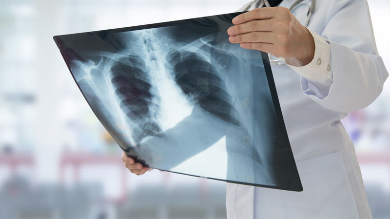 Áp xe phổi dễ nhầm lẫn với tràn dịch màng phổi