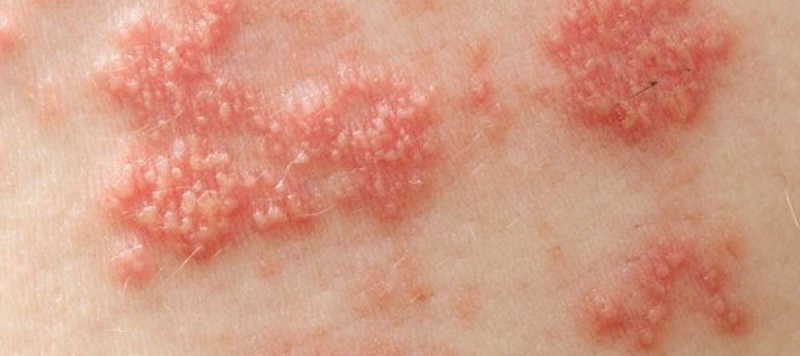 Ở Hoa Kỳ, herpes zoster xảy ra ở hơn 1,2 triệu người hàng năm