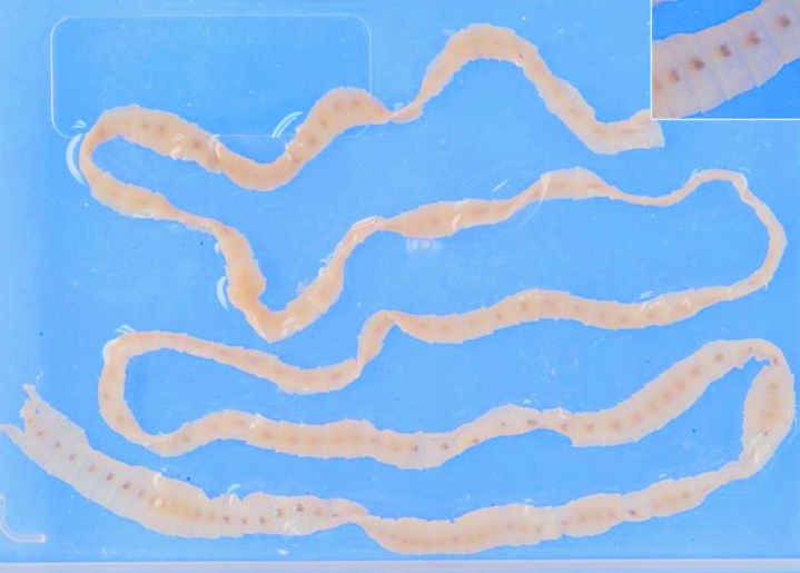 Bệnh sán Diphyllobothrium và Sparganum là bệnh do các loài sán dây: sán dây cá và ấu trùng sán nhái gây bệnh