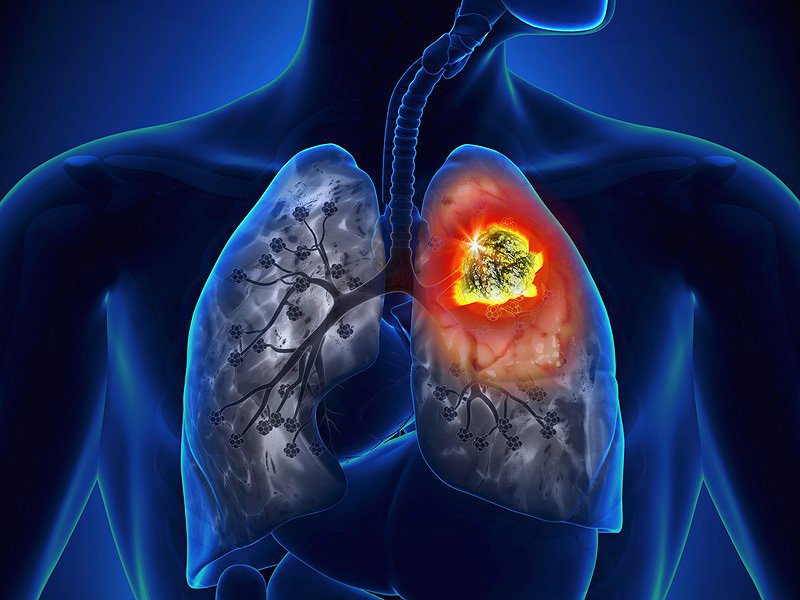 Ung thư phổi còn được gọi là ung thư biểu mô của phổi hoặc ung thư phế quản