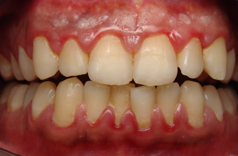Tụt nướu có thể do vị trí sai khớp cắn hoặc vị trí của răng