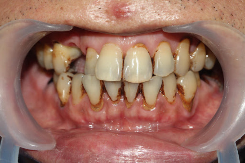 Viêm túi lợi quanh răng nếu không điều trị có thể gây hỏng răng
