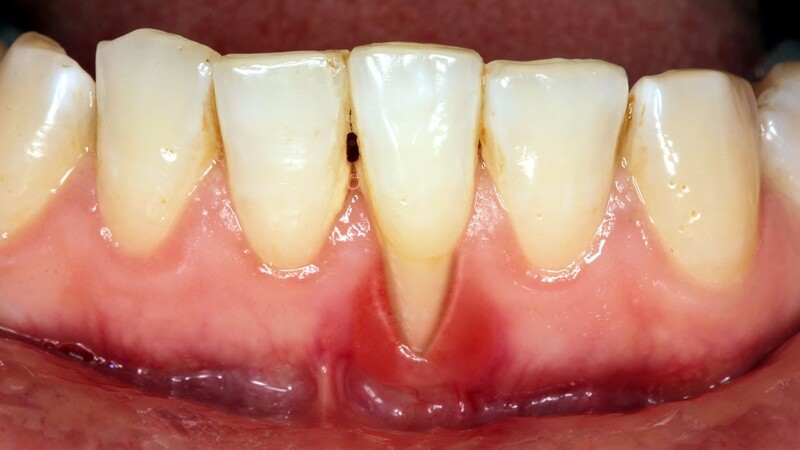 Tụt nướu thường gặp ở răng hàm dưới