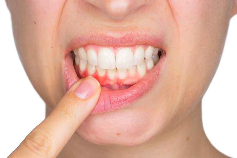 Tụt nướu khiến răng nhạy cảm, dễ ê buốt và tổn thương