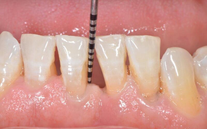 Loại bỏ cao răng là điều đầu tiên cần làm để điều trị tụt nướu