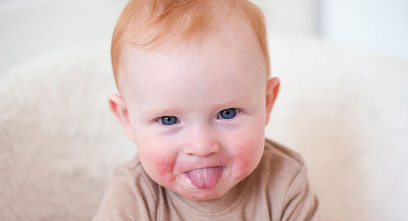Tình trạng nứt lưỡi có thể xuất hiện ở trẻ nhỏ