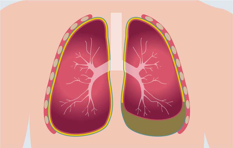 Màng phổi được cấu tạo từ 2 lớp mô mỏng và bao bọc bên ngoài phổi
