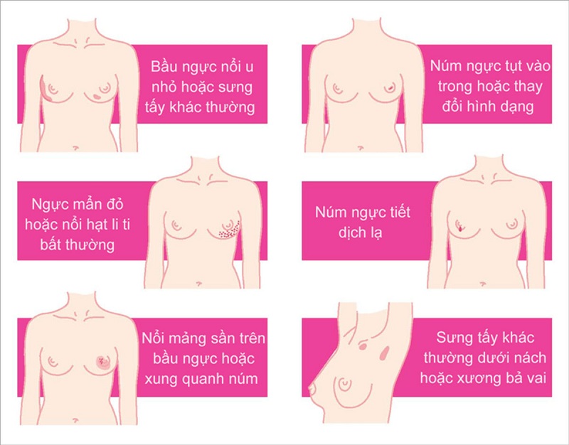 Các dấu hiệu cảnh báo ung thư vú từ giai đoạn sớm