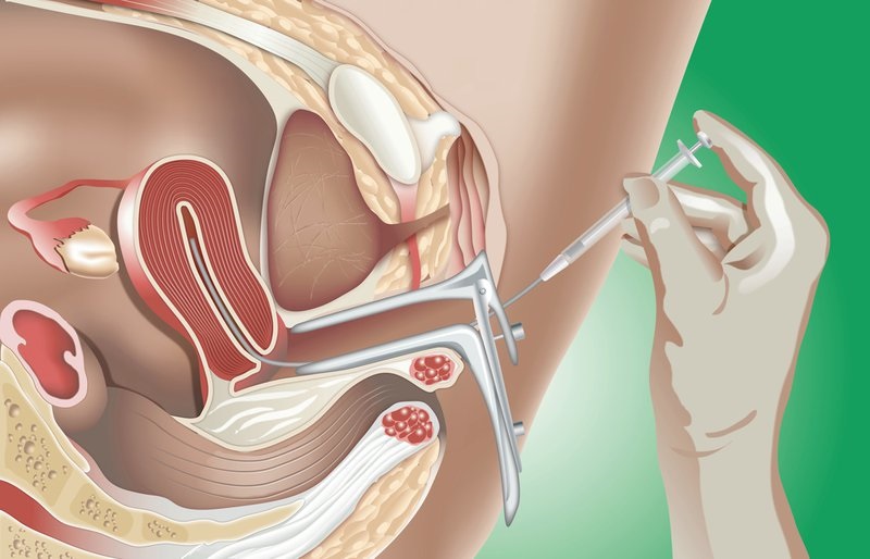 Phương pháp bơm tinh trùng vào buồng tử cung( hay còn gọi là IUI)