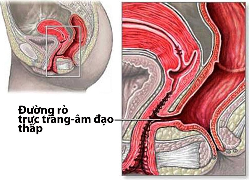 Rò âm đạo là hiện tượng hình thành lỗ rò bất thường giữa phần đại tràng - trực tràng - âm đạo