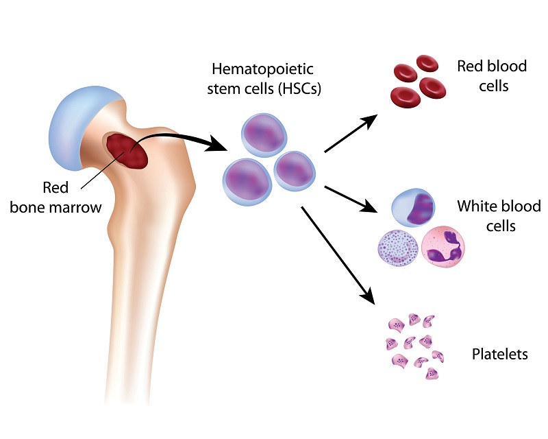 Nguyên nhân chính dẫn tới tình trạng loạn sản tủy xương là do sự rối loạn tế bào gốc tạo máu