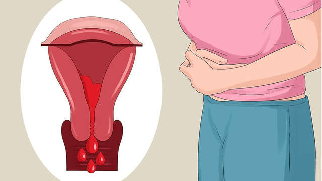 Lạc nội mạc tử cung khiến người phụ nữ bị đau bụng dữ dội đặc biệt là khi đến kỳ kinh nguyệt.