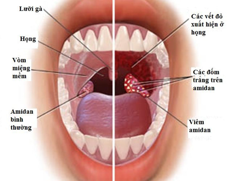 Amidan (tên đầy đủ là amidan khẩu cái) là tổ chức lympho lớn nhất ở họng miệng, thuộc hệ thống vòng bạch huyết Waldayer (gồm V.A, amidan vòi, amidan khẩu cái, amidan lưỡi)