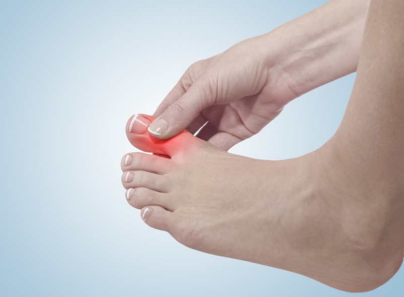 Viêm khớp dạng thấp có triệu chứng điển hình là sưng ngón chân