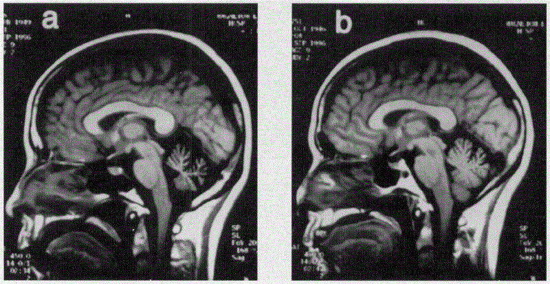 Các thất điều tủy - tiểu não (Spinocerebellar ataxias - SCA)