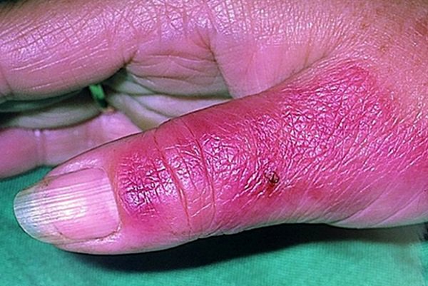 Người bệnh thường có hội chứng nhiễm trùng và các tổn thương da và mô dưới da đặc trưng.