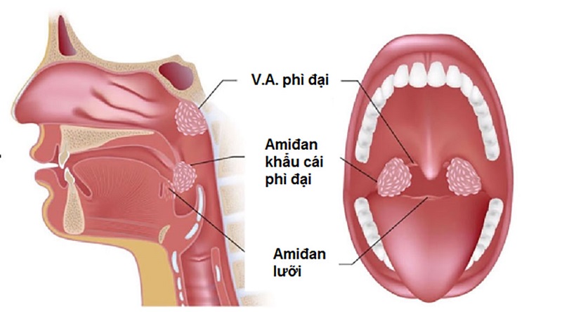  Hình ảnh giải phẫu VA