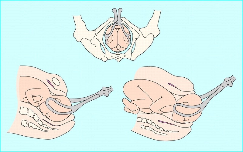 Hình ảnh mô tả hỗ trợ sinh bằng forceps