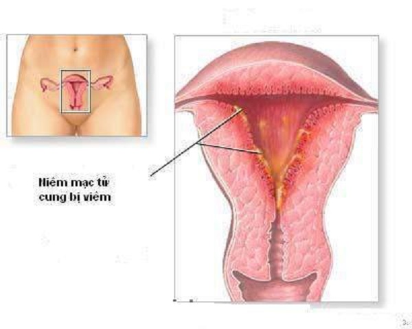 Nhiễm khuẩn hậu sản (NKHS) được định nghĩ là nhiễm khuẩn xảy ra ở những phụ nữ sau sinh bắt nguồn từ viêm nhiễm đường sinh dục ngoài hoặc niêm mạc tử cung