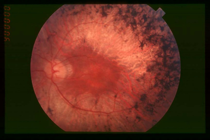 Điện sinh lý mắt giúp phát hiện tình trạng tổn thương võng mạc