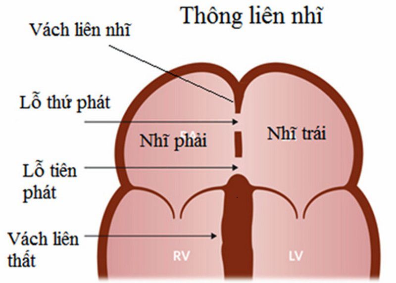Vách liên nhĩ bắt nguồn từ vách nguyên phát, vách thứ phát của sừng bên phải, phần sừng phải xoang tĩnh mạch