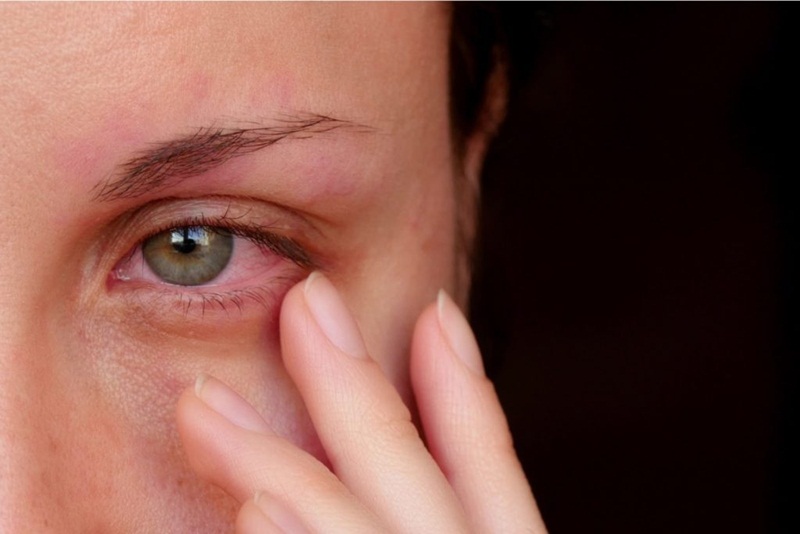 Người bệnh có cảm giác khô mắt và thường xuyên bị chảy nước mắt
