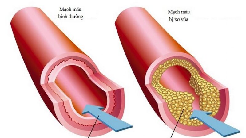 Xơ vữa động mạch dẫn đến hệ thống tuần hoàn ngoại vi kém