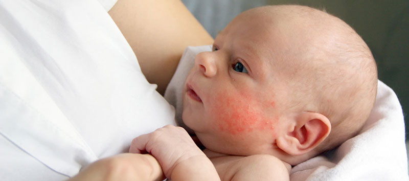 Bệnh viêm da cơ địa có thể di truyền cho em bé