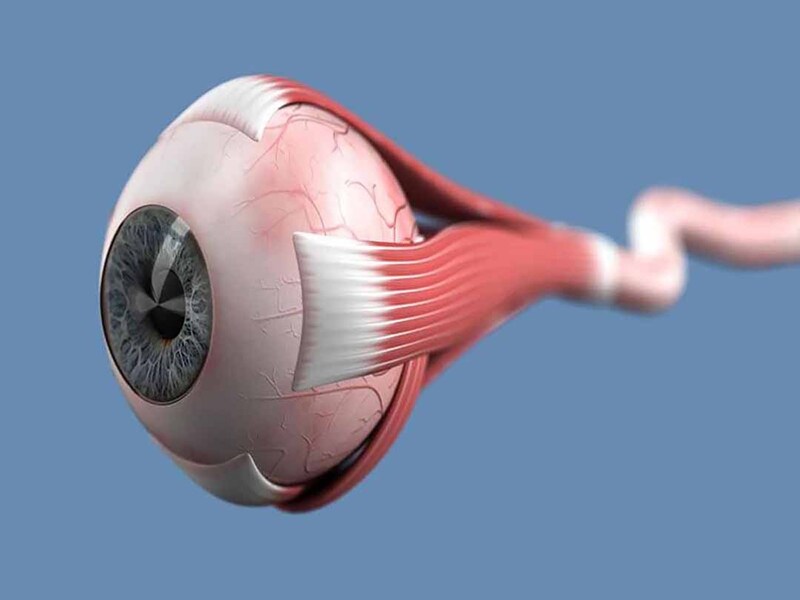 Mắt mờ đột ngột có thể do viêm dây thần kinh thị giác