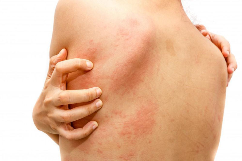Những vùng da dễ bị tổn thương là lưng, ngực và mặt