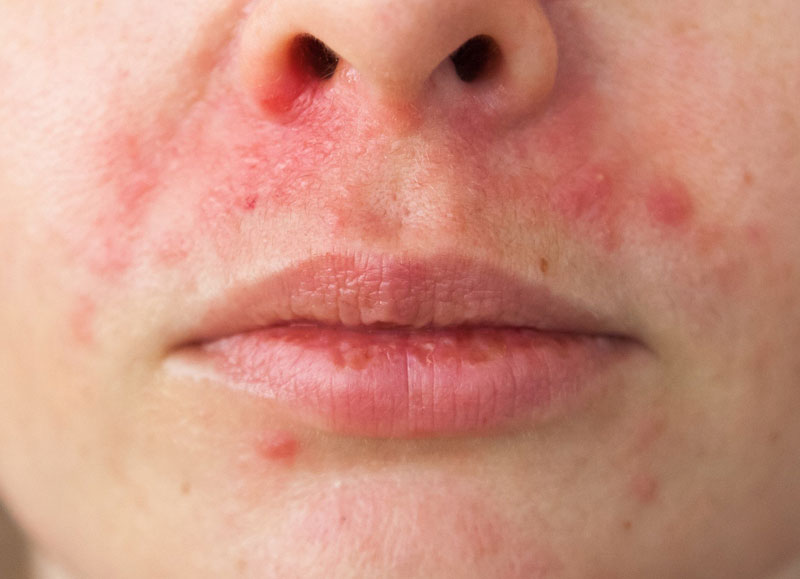Tình trạng viêm da quanh miệng xảy ra khá phổ biến