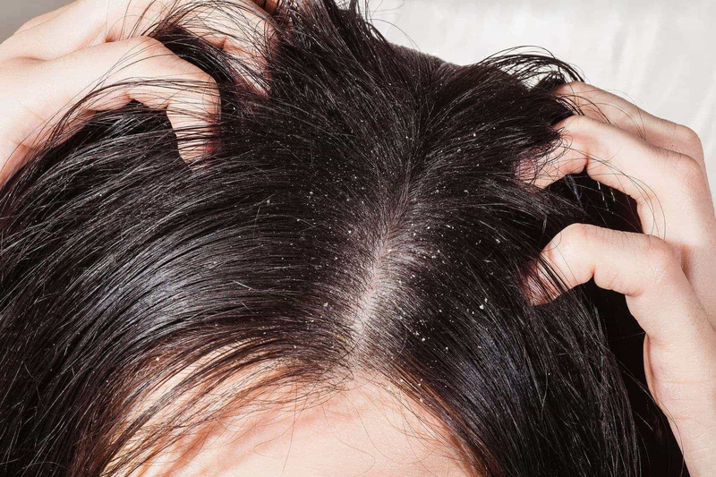 Cảm giác ngứa có thể do nhiễm nấm da đầu