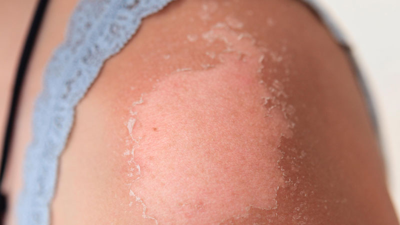 Mức độ cháy nắng trên da mỗi người có thể khác nhau