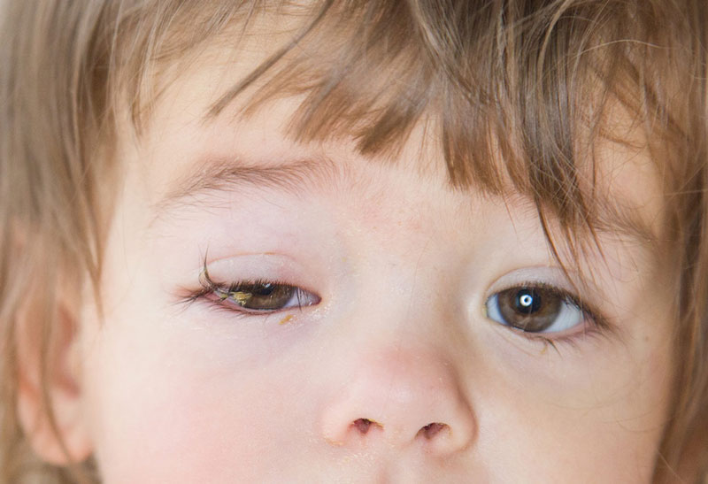 Trẻ sơ sinh cũng có nguy cơ mắc bệnh viêm kết mạc mắt
