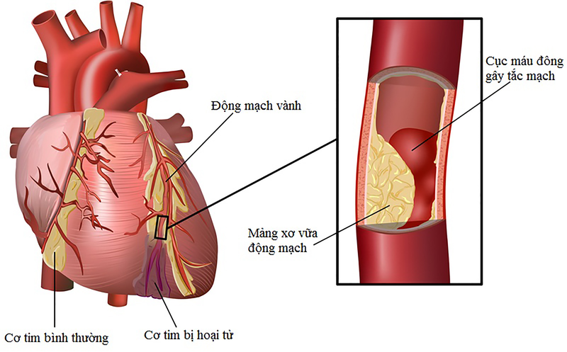 Dấu hiệu đau tức ngực cho thấy mỡ máu cao có thể đã gây biến chứng tim mạch