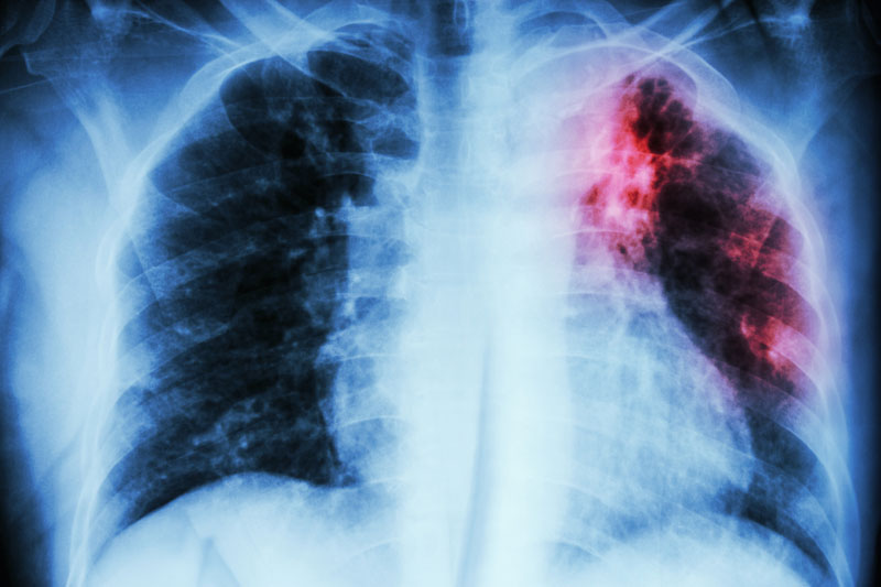 Lao phổi là căn bệnh truyền nhiễm phổ biến hiện nay