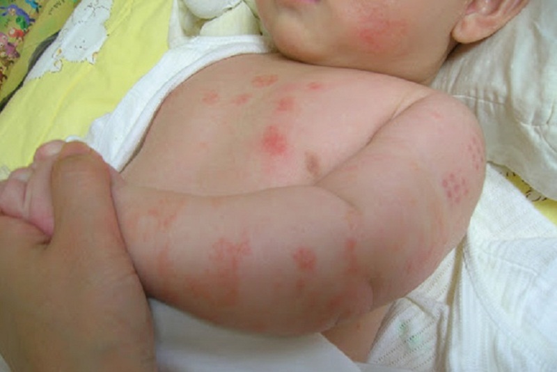 Bệnh tạo nên những mảng da có màu trắng, đỏ bất thường trên cơ thể của trẻ