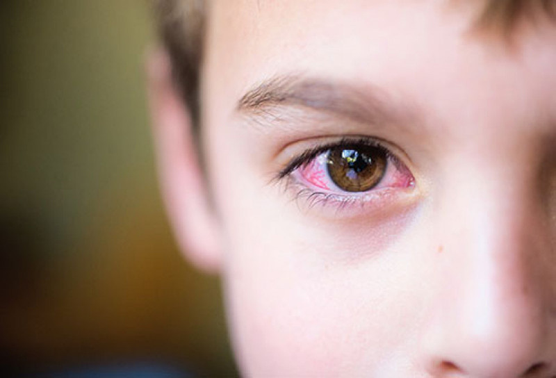Viêm kết mạc mắt có thể lây lan nếu do virus hoặc vi khuẩn