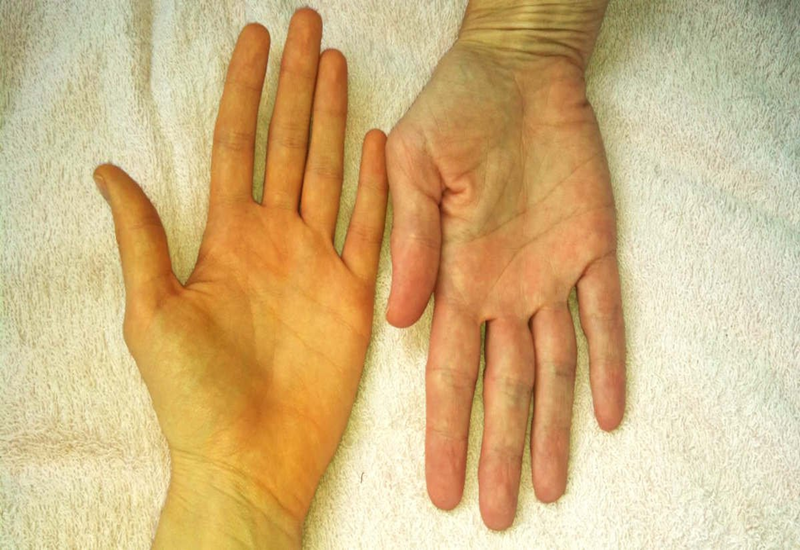 Bilirubin tích tụ lại trong cơ thể và gây ra tình trạng vàng da