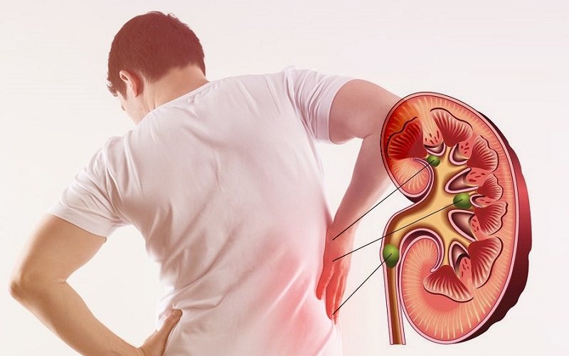 Người bệnh tiểu nhiều kèm các cơn đau bụng dưới kéo dài có thể dẫn đến suy thận