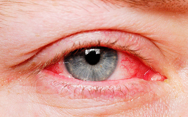 Các mạch máu nhỏ ở giác mạc bị vỡ sẽ gây ra tình trạng xuất huyết dưới mắt