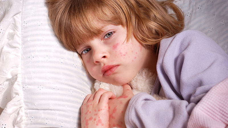 Có rất nhiều nguyên nhân gây ra xuất huyết dưới da ở trẻ em