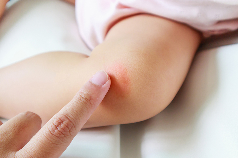 Xuất huyết dưới da ở trẻ em do chấn thương có thể điều trị dễ dàng tại nhà