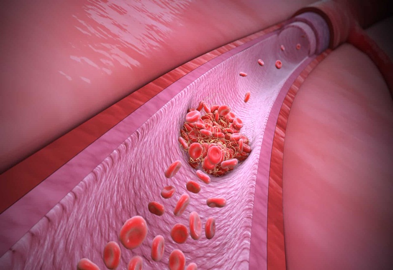 Khi thành mạch bị tổn thương, nút tiểu cầu được hình thành để lấp đầy mạch máu bị tổn thương