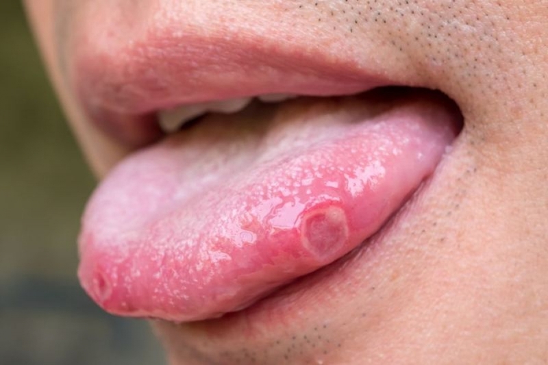 Nhiệt ở lưỡi là tình trạng tổn thương thường gặp gây đau đớn