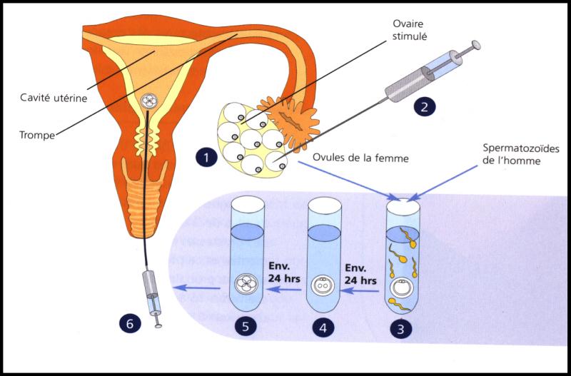 Hỗ trợ sinh sản bằng phương pháp IVF có thể mang đa thai