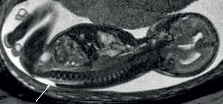 Hình ảnh MRI phát hiện dị tật thai nhi