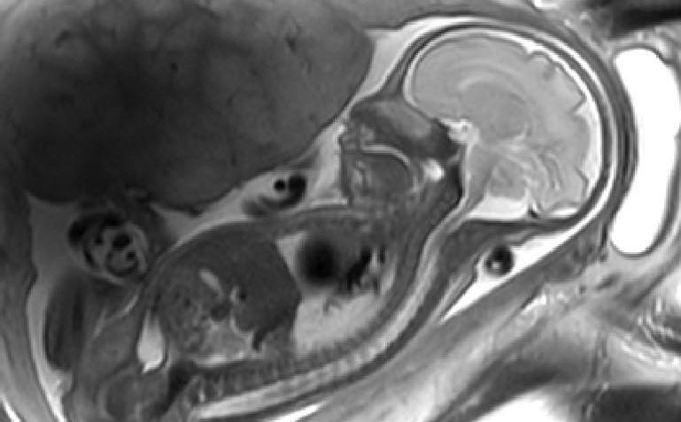 Hình ảnh thai nhi trong chụp MRI